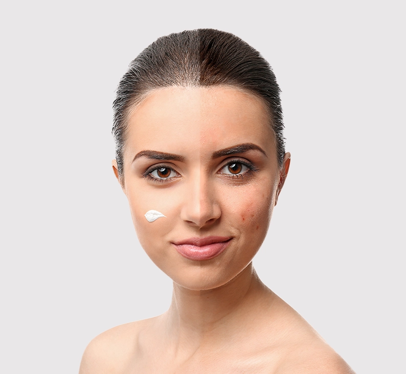 Anti Acne Range